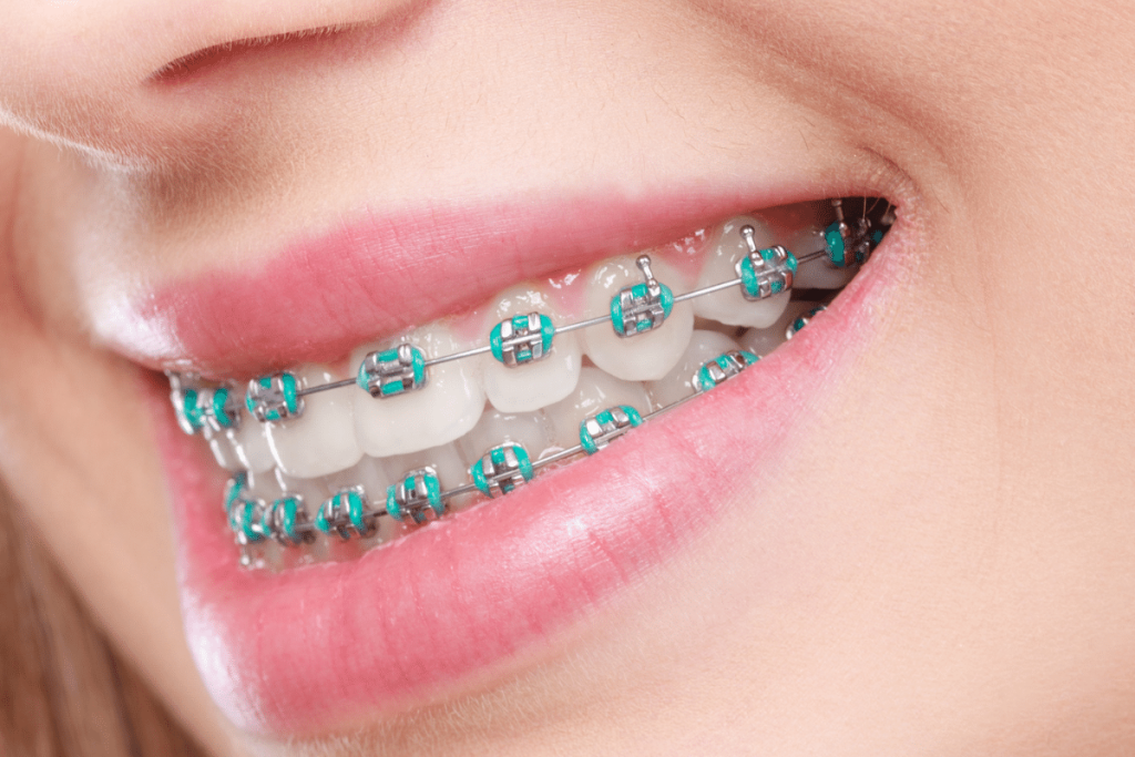 What are the color options for braces?