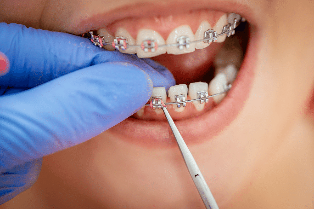 Getting your braces off! What you should expect