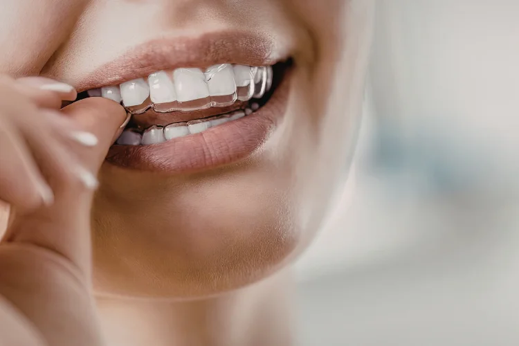 Close-up of a person placing clear aligners on their teeth, highlighting Invisalign-style orthodontic treatment and a bright smile