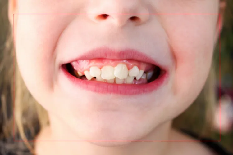 Child with crowded and misaligned teeth showing signs that an orthodontic evaluation may be needed.